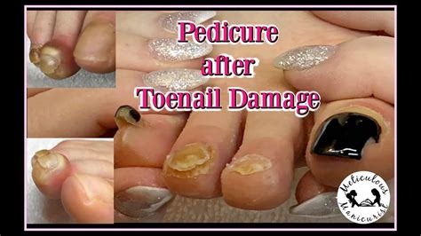 Why do pedicures damage toenails?