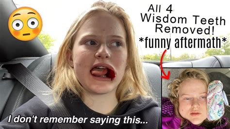 Why do people act weird after wisdom teeth removal?