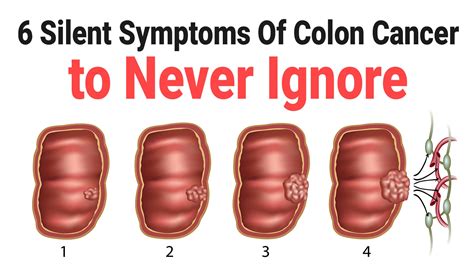 Why do people cancel colonoscopy?