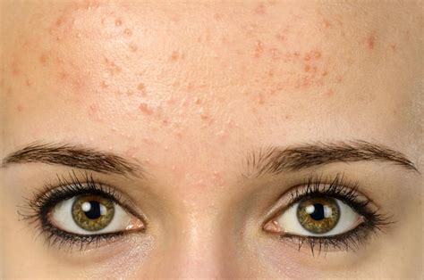 Why do people with acne look younger?