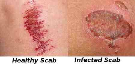 Why do scabs turn white when wet?