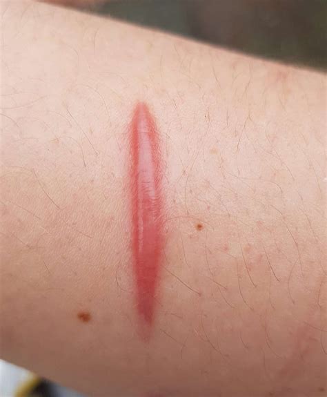 Why do scars go from red to white?