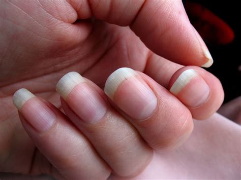 Why do short nails hurt?