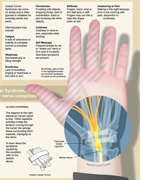 Why do some people never get carpal tunnel?