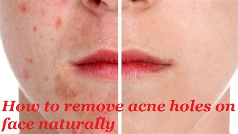 Why does acne leave holes?