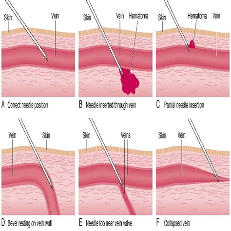 Why does blood boil during decompression?