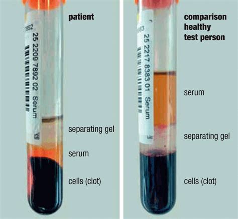 Why does blood gel?