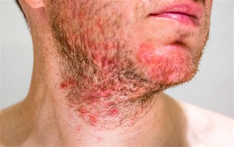 Why does folliculitis itch more at night?