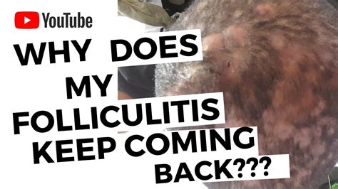 Why does folliculitis keep coming back?