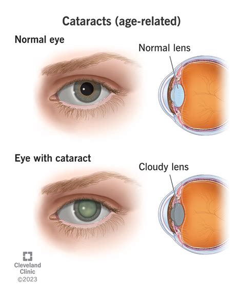 Why does glare occur in cataract?