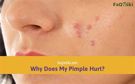 Why does my pimple hurt when I touch it?