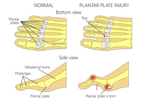 Why does my second toe hurt when I run?