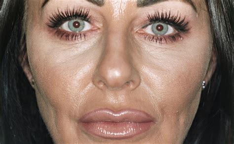 Why does my skin look better after Botox?