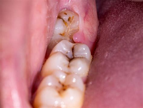 Why does pericoronitis hurt so bad?