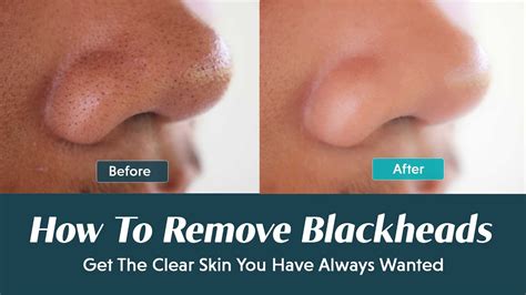 Why does removing blackheads feel good?