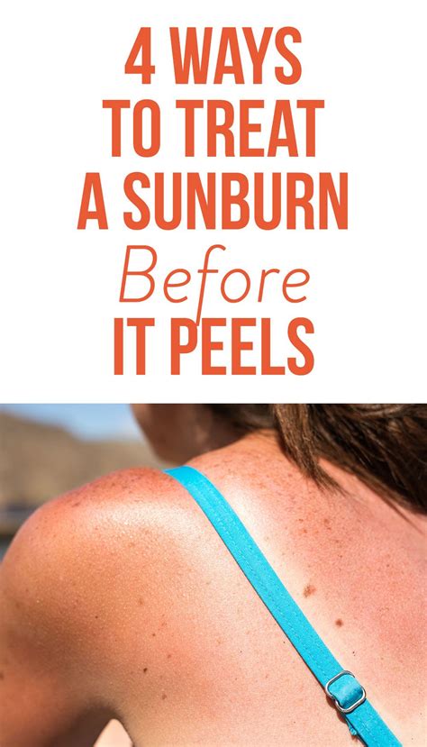 Why does sunburn clear acne?