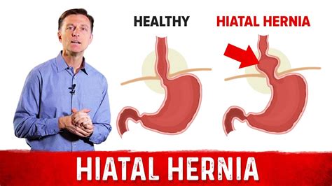 Why don t doctors repair hiatal hernias?