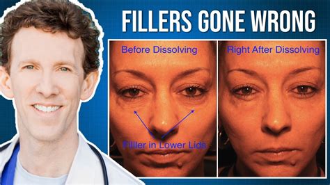 Why has my filler gone hard?