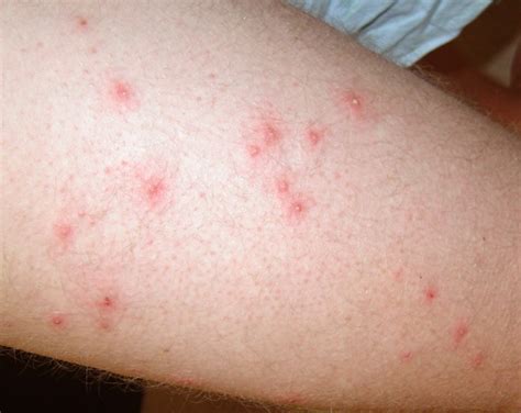 Why have I had folliculitis for months?