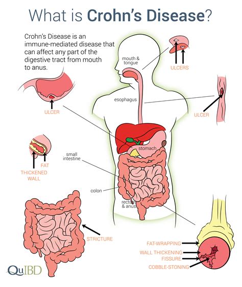 Why is Crohn's so painful?