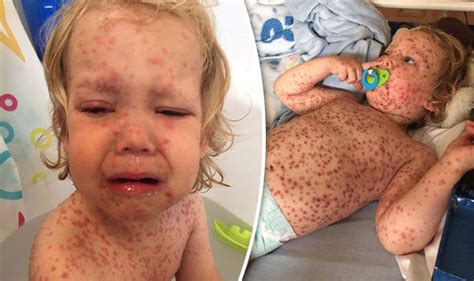 Why is chickenpox worse for adults?