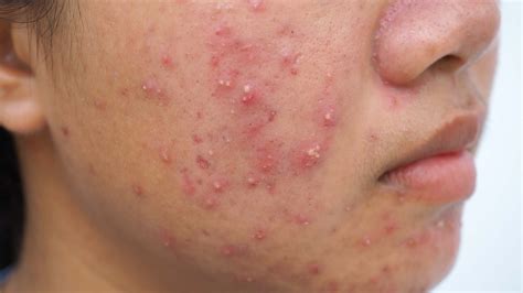 Why is cystic acne so hard?