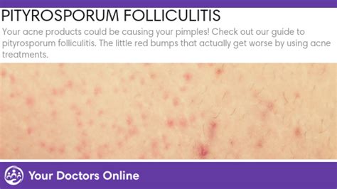 Why is folliculitis worse in summer?
