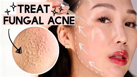 Why is fungal acne so hard to get rid of?