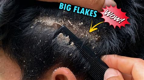 Why is it satisfying to scratch dandruff?