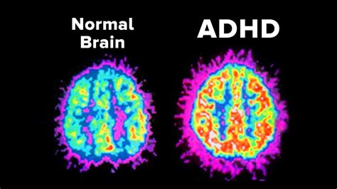 Why is living with ADHD so hard?