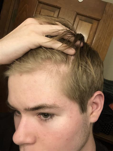 Why is my 13 year old son losing hair?