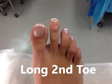 Why is my 2nd toe longer than my big toe?