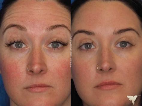 Why is my Botox uneven after 1 week?