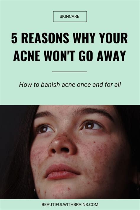 Why is my acne not going away?