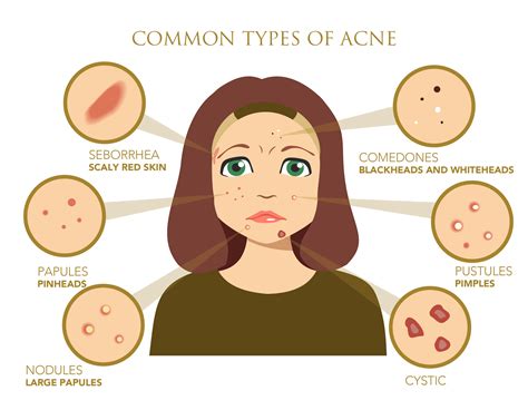 Why is my acne so bad?