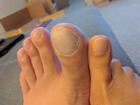 Why is my big toe white?