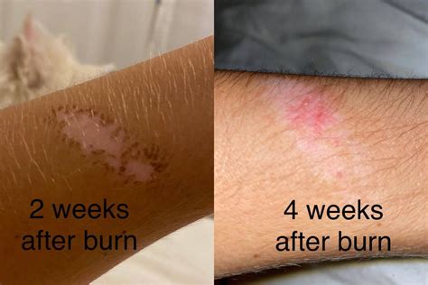 Why is my burn still pink?