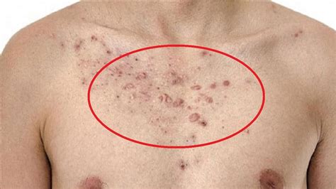 Why is my chest acne not going away?