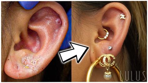 Why is my ear piercing crusty after years?