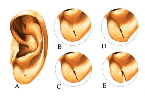 Why is my earlobe split in half?