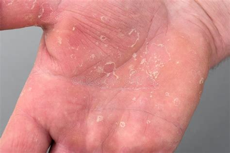 Why is my eczema peeling?