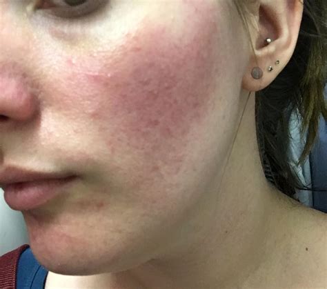 Why is my face red after skincare?