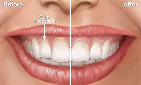 Why is my gum receding on 1 tooth?