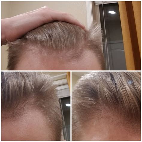 Why is my hair thinning in the front but thick in the back?