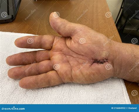 Why is my hand worse after carpal tunnel surgery?