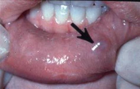 Why is my mucocele turning white?