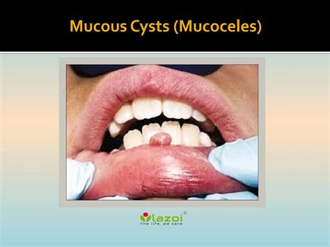 Why is my mucocele turning yellow?