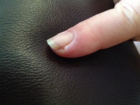 Why is my nail white after injury?