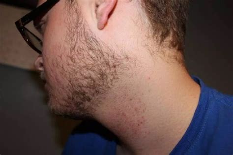 Why is my neck so sensitive to shaving?