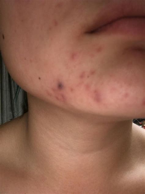 Why is my pimple turning black without popping?